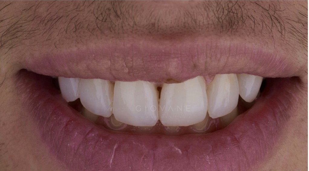 Il sorriso di Giacomo dopo il trattamento