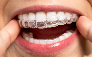 L’ortodonzia come terapia per gli adulti